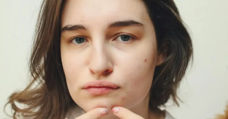 How to Feel Confident With Acne - My Best-Kept Secrets How to Feel Confident With Acne - My Best-Kept Secrets