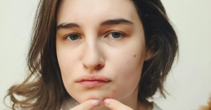 How to Feel Confident With Acne - My Best-Kept Secrets How to Feel Confident With Acne - My Best-Kept Secrets